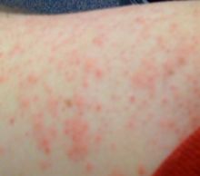 My shoulder today.